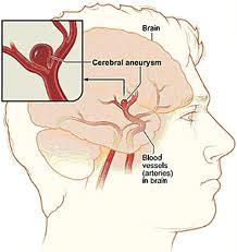 10 semne ale atacului cerebral